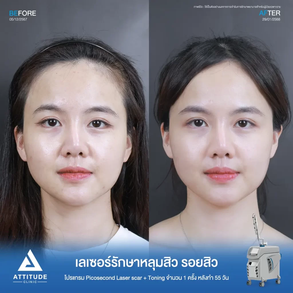น้องกันเองพามาส่องรีวิว รอบนี้เป็นคิวของพี่แอนฟิลด์มาทำโปรแกรม Picosecond Laser รีวิวเลเซอร์ครั้งแรกที่ Attitude Clinic ค้าบ~