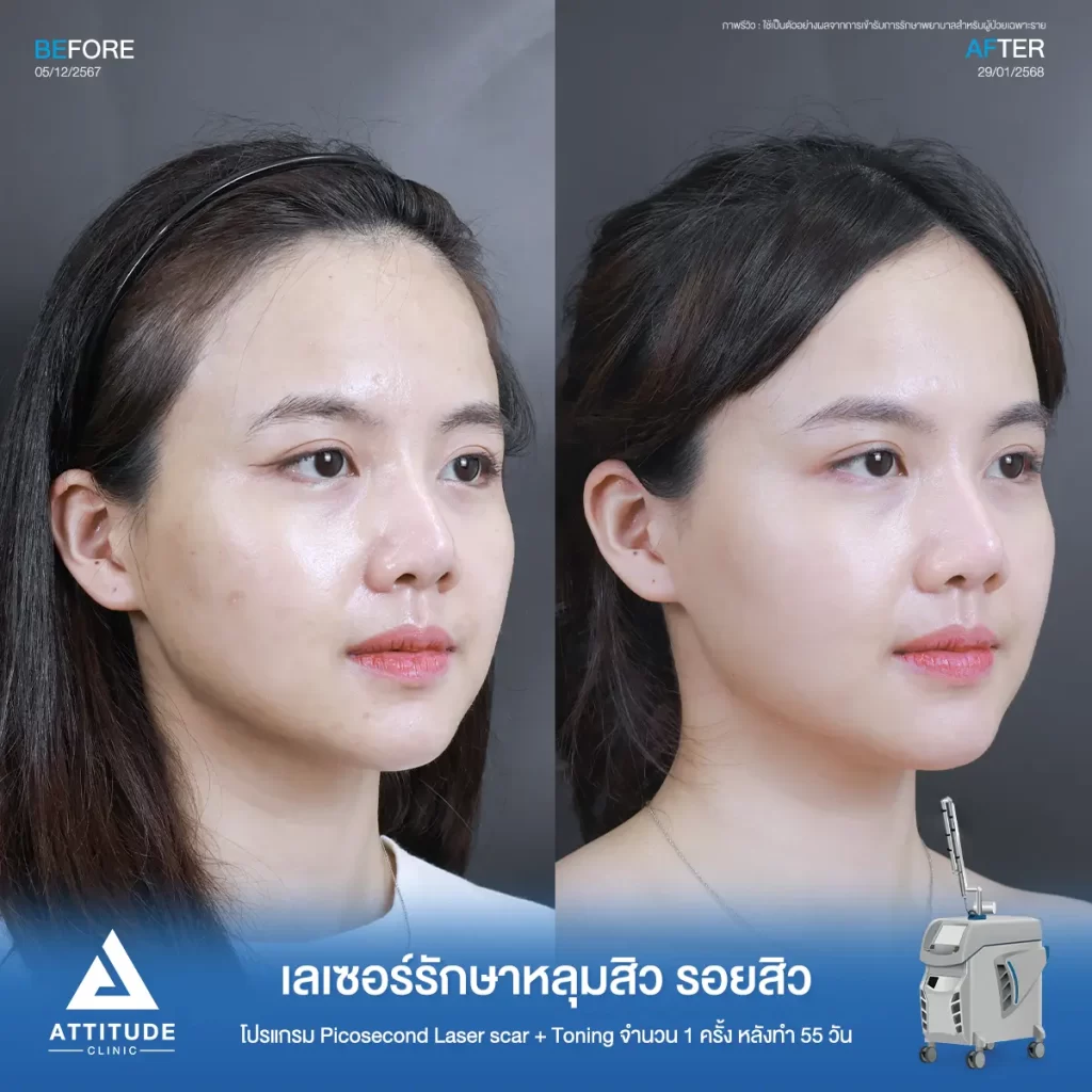 น้องกันเองพามาส่องรีวิว รอบนี้เป็นคิวของพี่แอนฟิลด์มาทำโปรแกรม Picosecond Laser รีวิวเลเซอร์ครั้งแรกที่ Attitude Clinic ค้าบ~