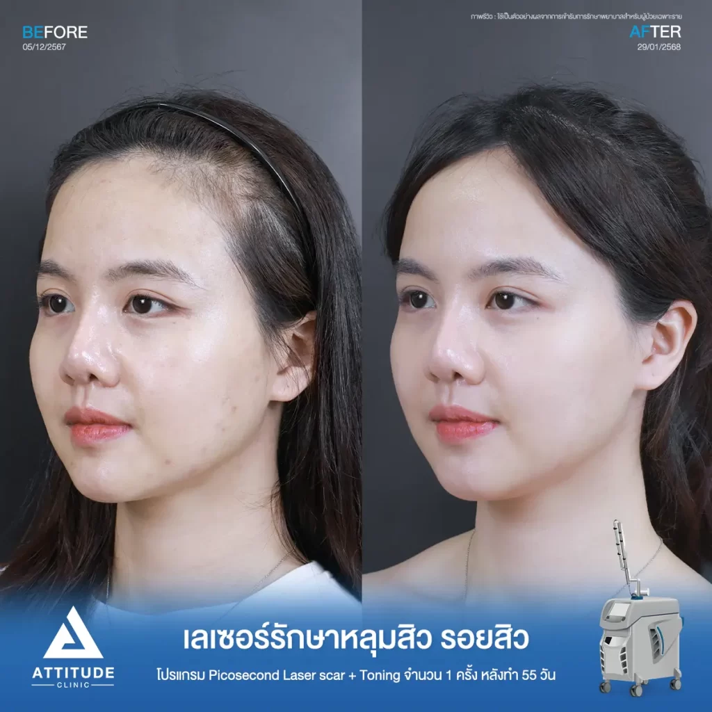 น้องกันเองพามาส่องรีวิว รอบนี้เป็นคิวของพี่แอนฟิลด์มาทำโปรแกรม Picosecond Laser รีวิวเลเซอร์ครั้งแรกที่ Attitude Clinic ค้าบ~