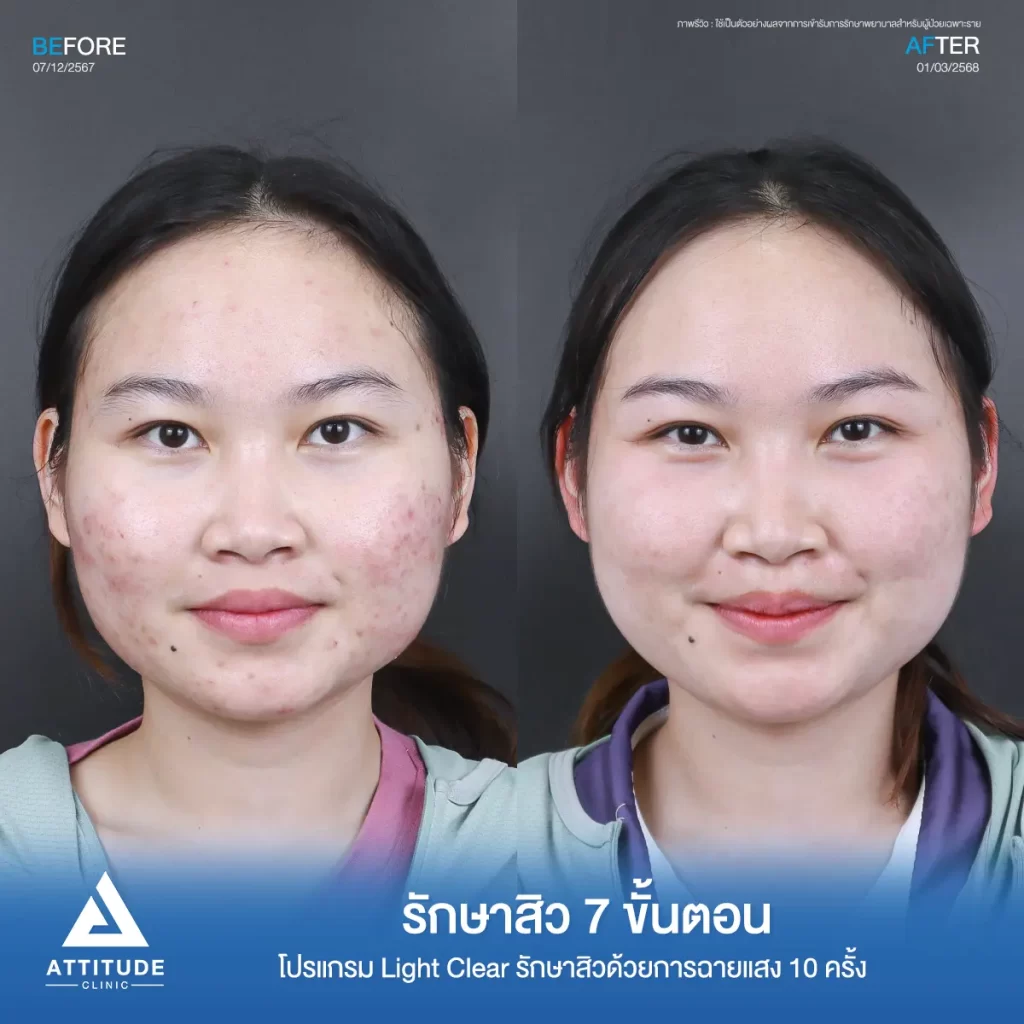 รีวิวรักษาสิวพี่นัน โปรแกรม Light Clear รักษาสิว 7 ขั้นตอน จำนวน 10 ครั้งที่ Attitude Clinic