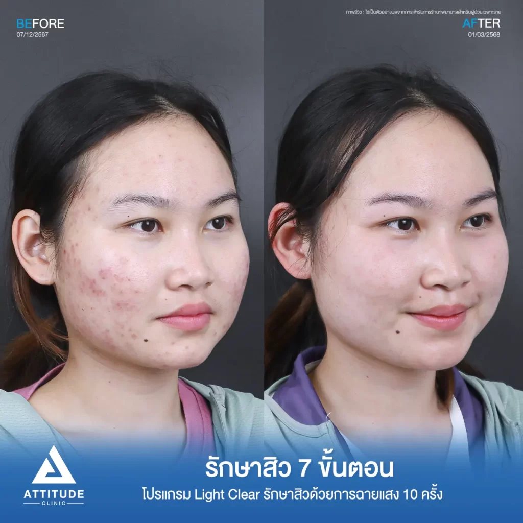 รีวิวรักษาสิวพี่นัน โปรแกรม Light Clear รักษาสิว 7 ขั้นตอน จำนวน 10 ครั้งที่ Attitude Clinic