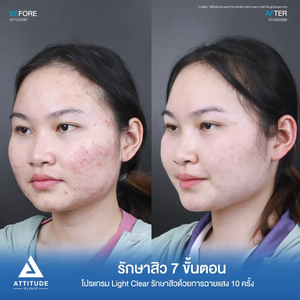 รีวิวรักษาสิวพี่นัน โปรแกรม Light Clear รักษาสิว 7 ขั้นตอน จำนวน 10 ครั้งที่ Attitude Clinic