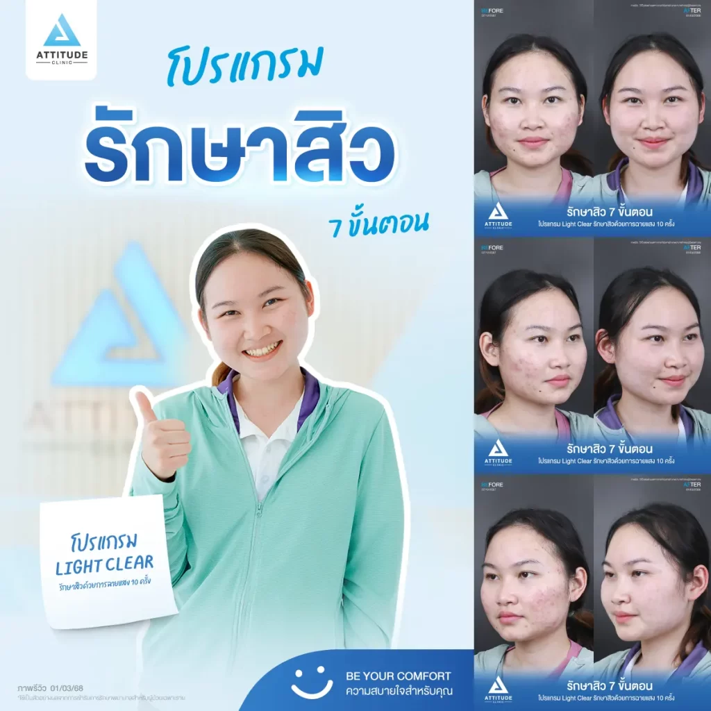 รีวิวรักษาสิวพี่นัน โปรแกรม Light Clear รักษาสิว 7 ขั้นตอน จำนวน 10 ครั้งที่ Attitude Clinic