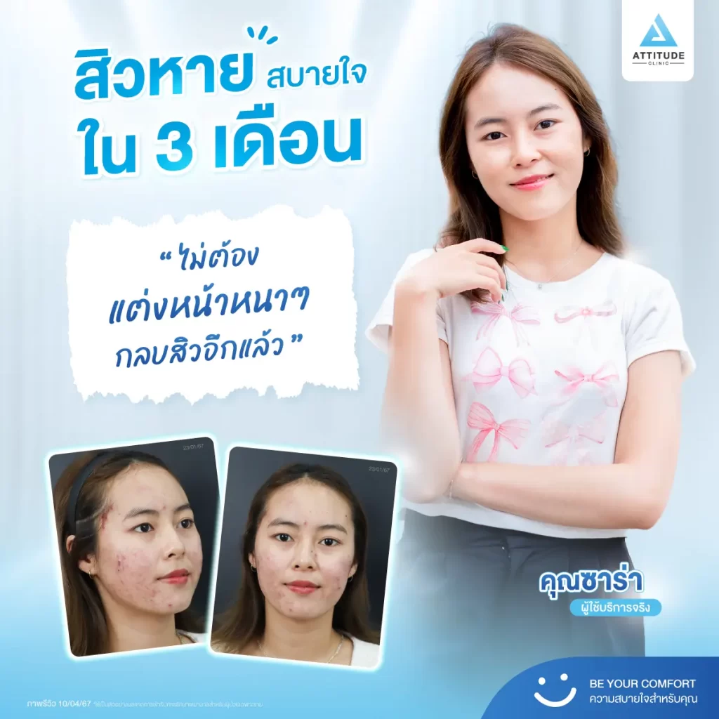 สิวหาย สบายใจใน 3 เดือน ผลลัพธ์การรักษาสิวจากพี่ซาร่า คนไข้ที่ใช้บริการจริงของคลินิกค้าบ