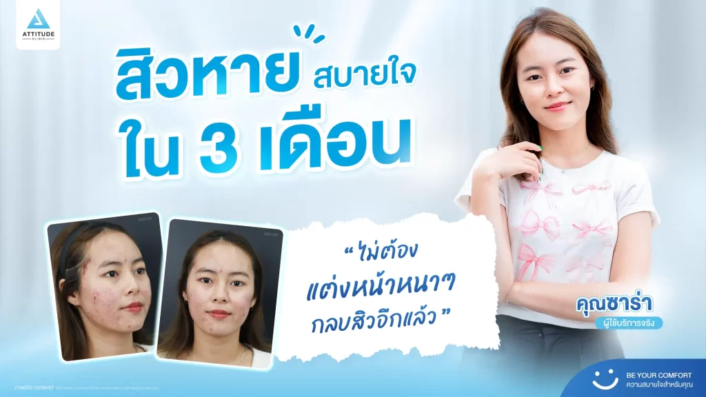สิวหาย สบายใจใน 3 เดือน ผลลัพธ์การรักษาสิวจากพี่ซาร่า คนไข้ที่ใช้บริการจริงของคลินิกค้าบ