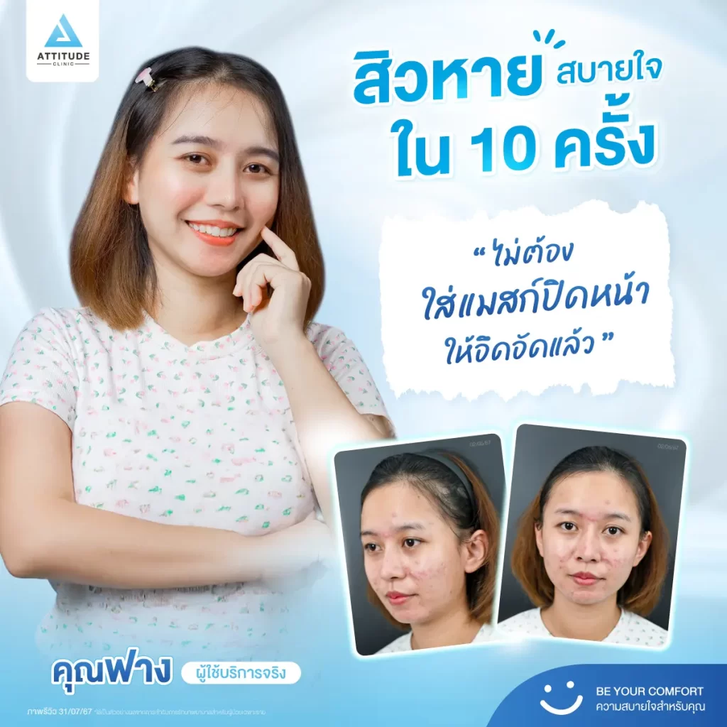 สิวหาย สบายใจใน 10 ครั้ง พี่ฟางคอนเฟิร์มให้เลย เพราะใช้บริการเองจนสิวหายมาแล้วค้าบ