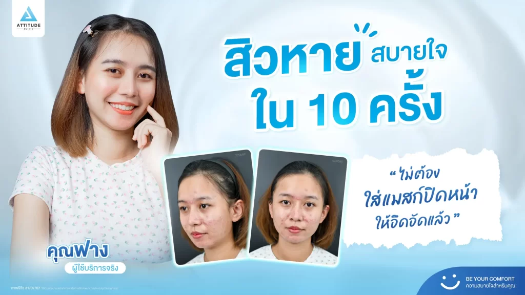 สิวหาย สบายใจใน 10 ครั้ง พี่ฟางคอนเฟิร์มให้เลย เพราะใช้บริการเองจนสิวหายมาแล้วค้าบ