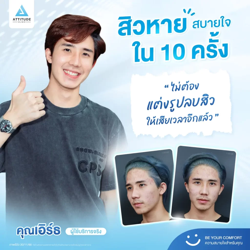 สิวหาย สบายใจใน 10 ครั้ง คอนเฟิร์มอีก 1 เสียงจากพี่เอิร์ธ หนุ่มหล่อลูกค้าประจำของคลินิกค้าบ
