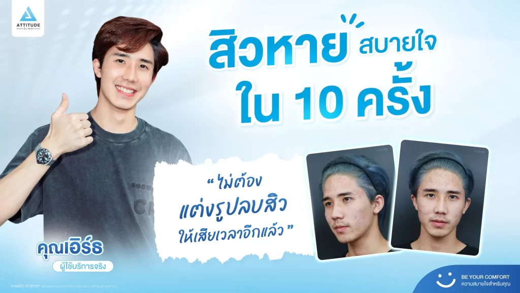 สิวหาย สบายใจใน 10 ครั้ง คอนเฟิร์มอีก 1 เสียงจากพี่เอิร์ธ หนุ่มหล่อลูกค้าประจำของคลินิกค้าบ