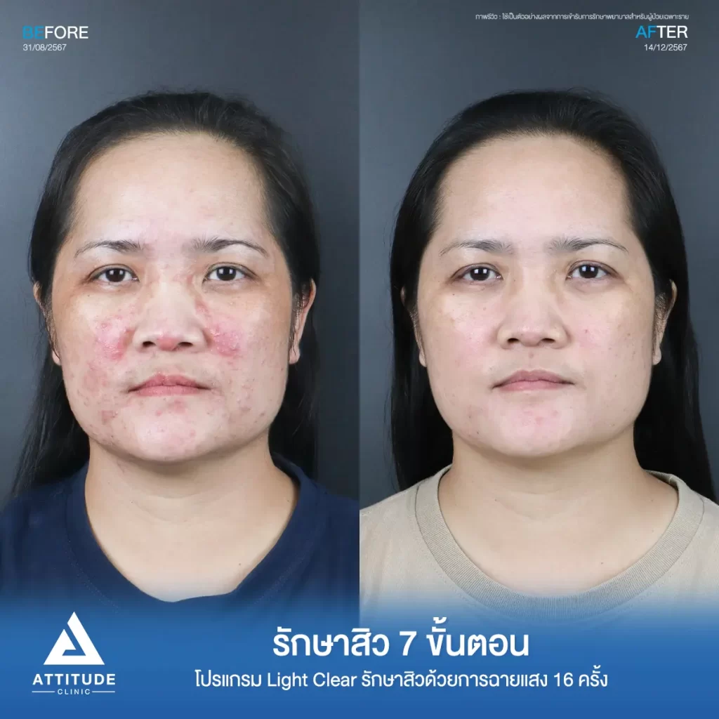 รีวิวรักษาสิวพี่นาย โปรแกรม Light Clear รักษาสิว 7 ขั้นตอน จำนวน 16 ครั้งที่ Attitude Clinic