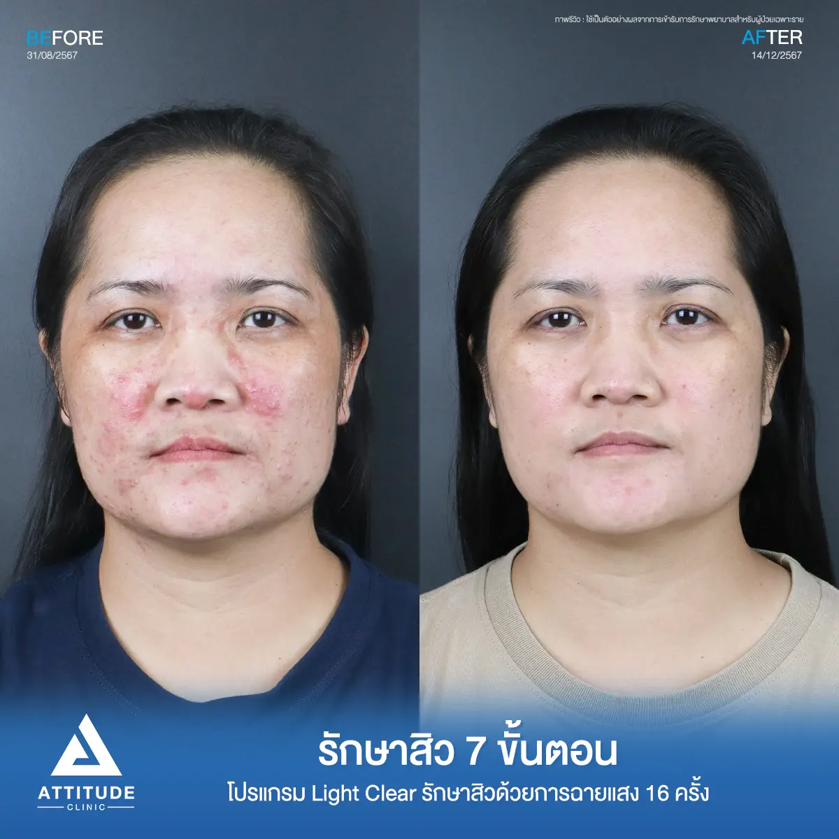 รีวิวรักษาสิวพี่นาย โปรแกรม Light Clear รักษาสิว 7 ขั้นตอน จำนวน 16 ครั้งที่ Attitude Clinic