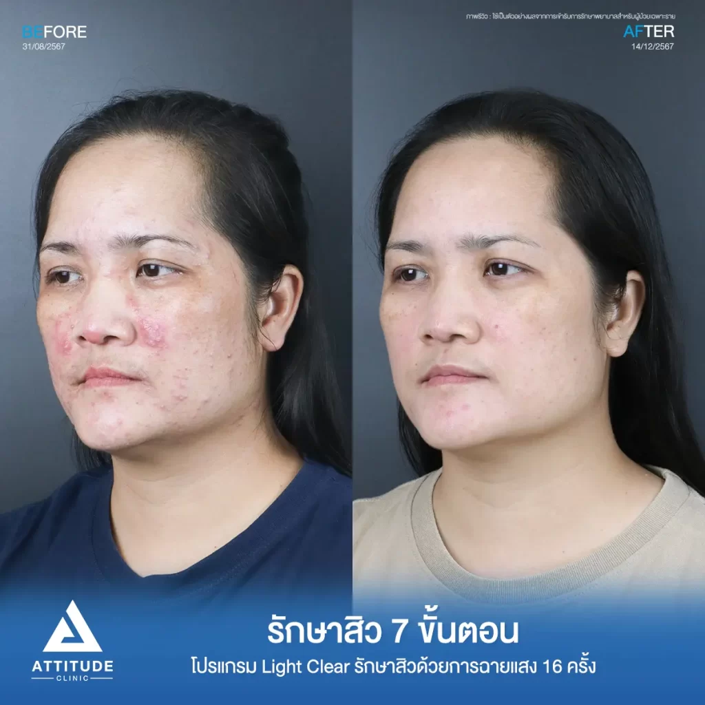 รีวิวรักษาสิวพี่นาย โปรแกรม Light Clear รักษาสิว 7 ขั้นตอน จำนวน 16 ครั้งที่ Attitude Clinic
