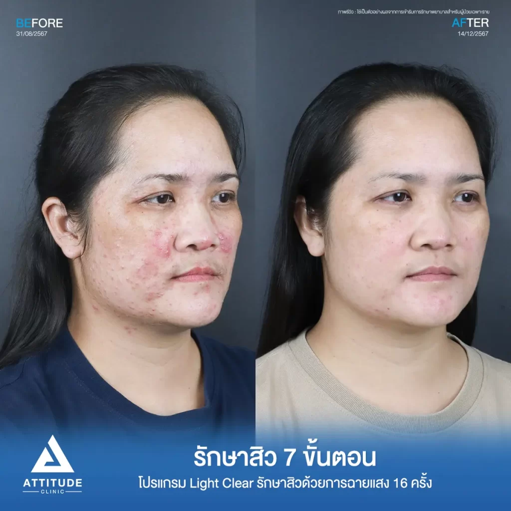รีวิวรักษาสิวพี่นาย โปรแกรม Light Clear รักษาสิว 7 ขั้นตอน จำนวน 16 ครั้งที่ Attitude Clinic