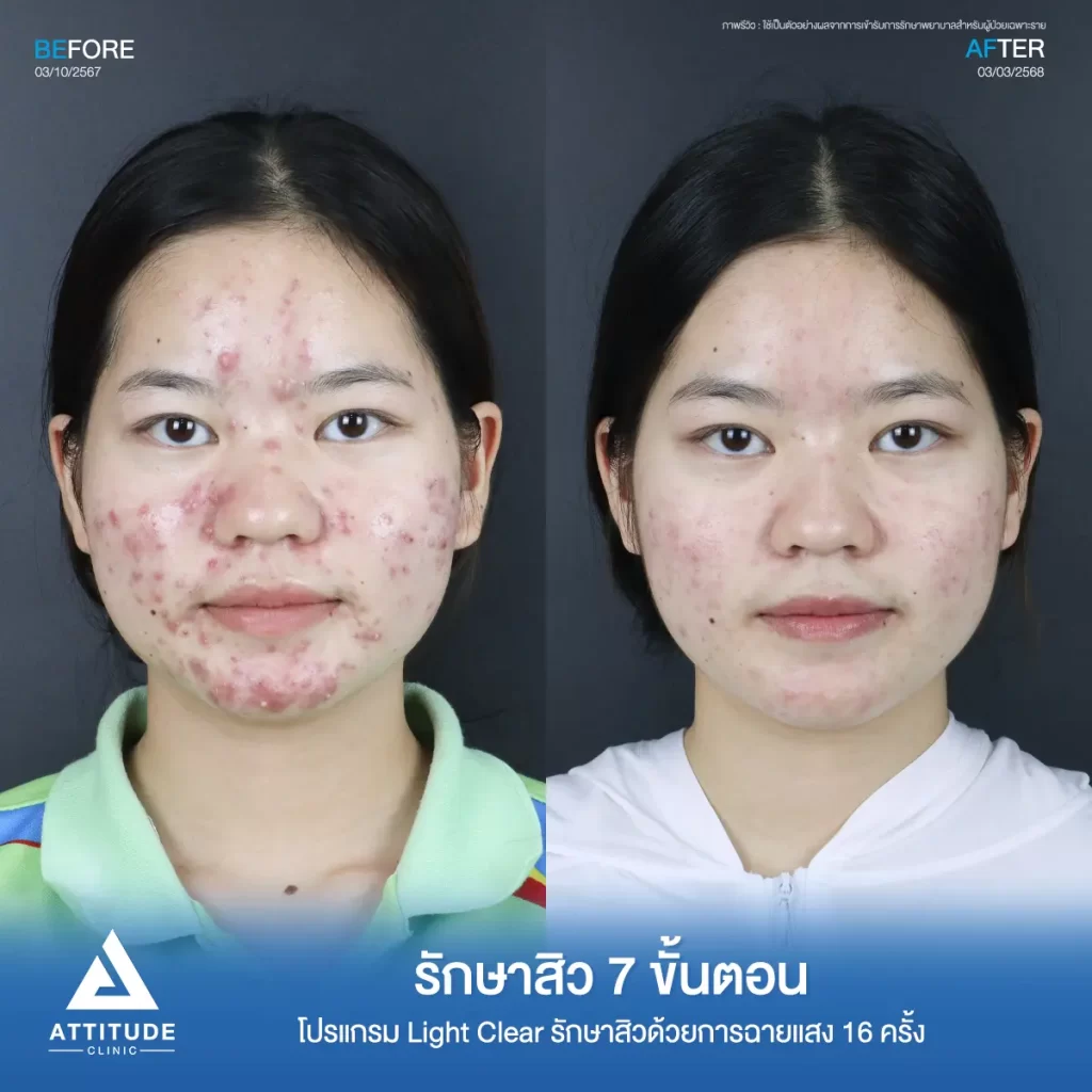 รีวิวรักษาสิวพี่สาย โปรแกรม Light Clear รักษาสิว 7 ขั้นตอน จำนวน 16 ครั้งที่ Attitude Clinic