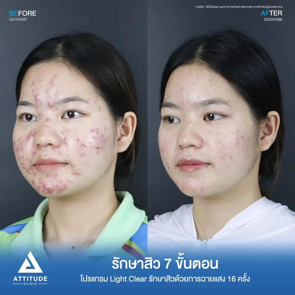 รีวิวรักษาสิวพี่สาย โปรแกรม Light Clear รักษาสิว 7 ขั้นตอน จำนวน 16 ครั้งที่ Attitude Clinic