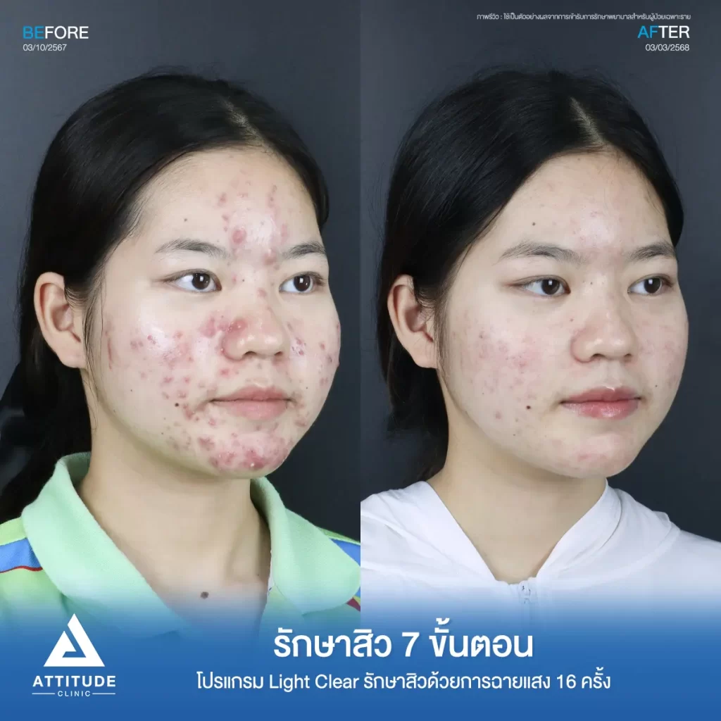 รีวิวรักษาสิวพี่สาย โปรแกรม Light Clear รักษาสิว 7 ขั้นตอน จำนวน 16 ครั้งที่ Attitude Clinic