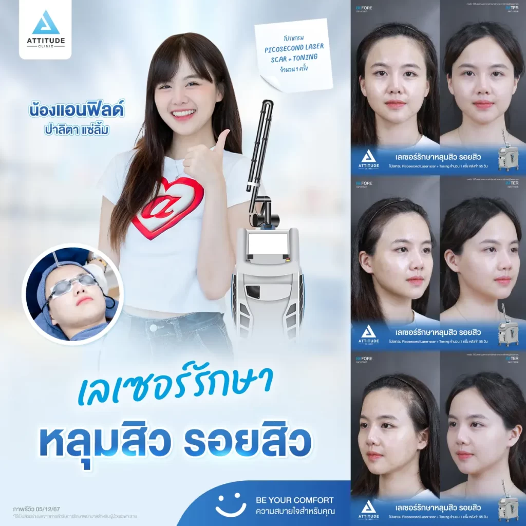 น้องกันเองพามาส่องรีวิว รอบนี้เป็นคิวของพี่แอนฟิลด์มาทำโปรแกรม Picosecond Laser รีวิวเลเซอร์ครั้งแรกที่ Attitude Clinic ค้าบ~