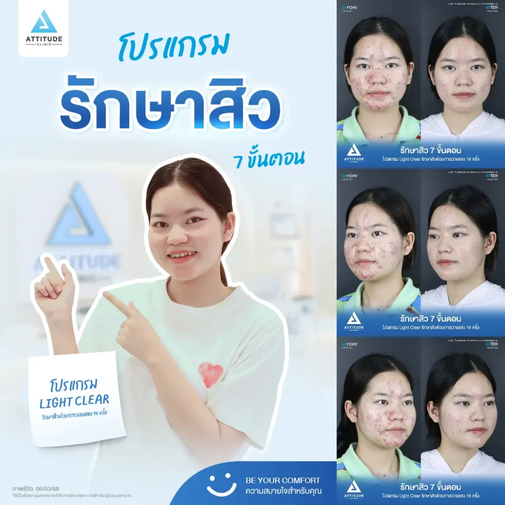 รีวิวรักษาสิวพี่สาย โปรแกรม Light Clear รักษาสิว 7 ขั้นตอน จำนวน 16 ครั้งที่ Attitude Clinic