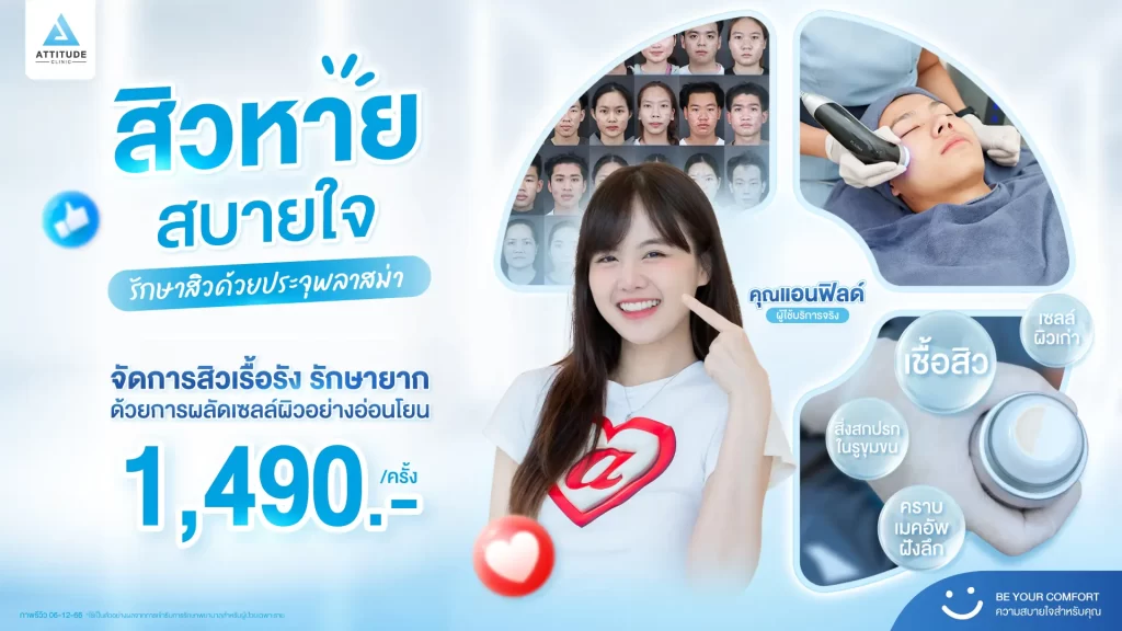 สิวหาย สบายใจ รักษาสิวด้วยประจุพลาสม่าเพียง 1,490.-