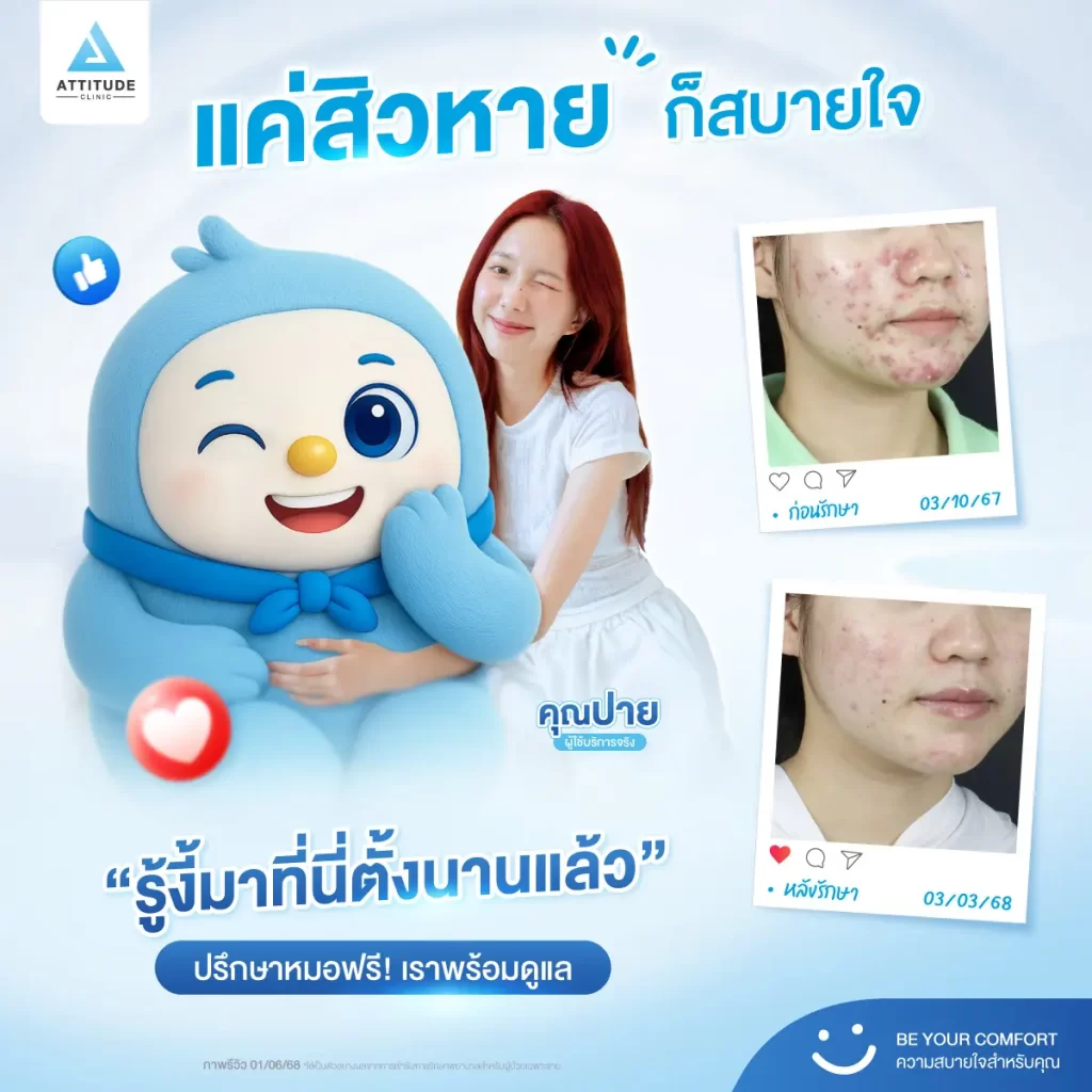 แค่สิวหาย ก็สบายใจแล้ว น้องกันเองคอนเฟิร์มจากพี่ๆ ที่เข้ามารักษาสิวที่แอททิจูดคลินิกบอกเป็นเสียงเดียวกันว่า "รู้งี้มารักษาสิวที่นี่ตั้งนานแล้ว"
