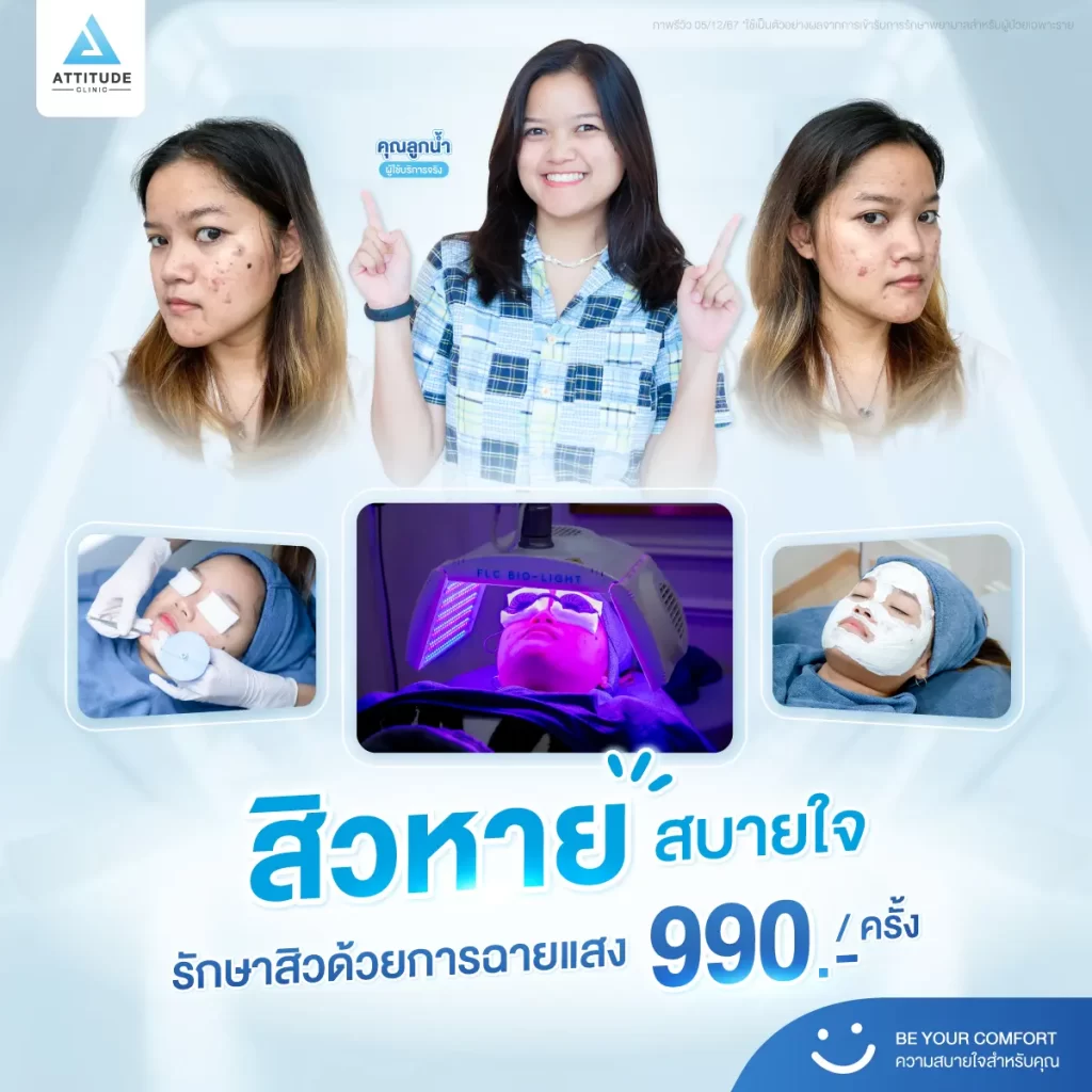 สิวหาย สบายใจ รักษาสิวด้วยการฉายแสงเพียง 990.-