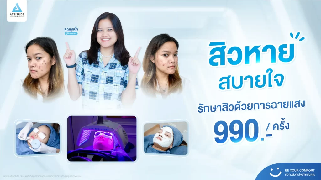 สิวหาย สบายใจ รักษาสิวด้วยการฉายแสงเพียง 990.-