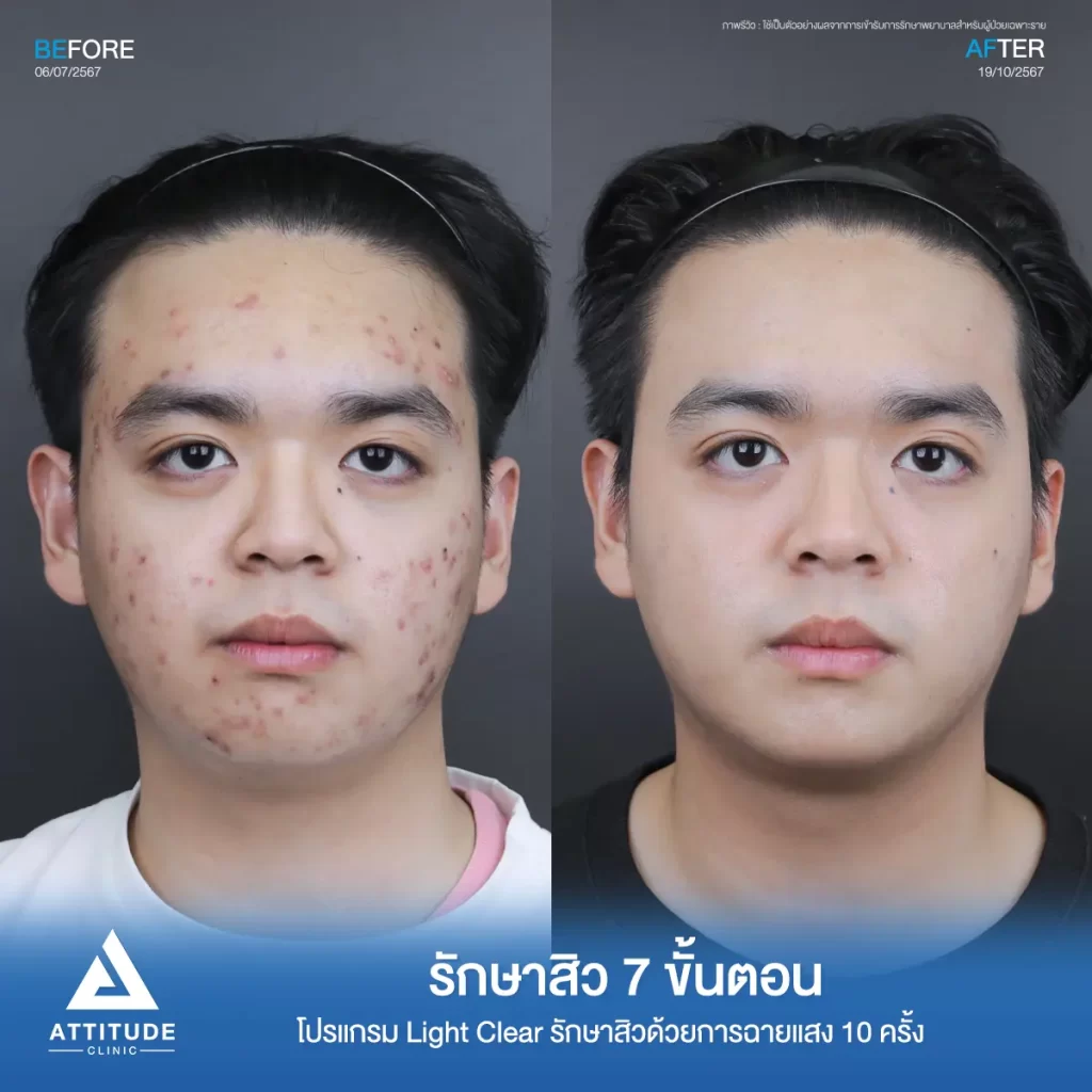 รีวิวรักษาสิวพี่ก้องภพ โปรแกรม Light Clear รักษาสิว 7 ขั้นตอน จำนวน 10 ครั้งที่ Attitude Clinic