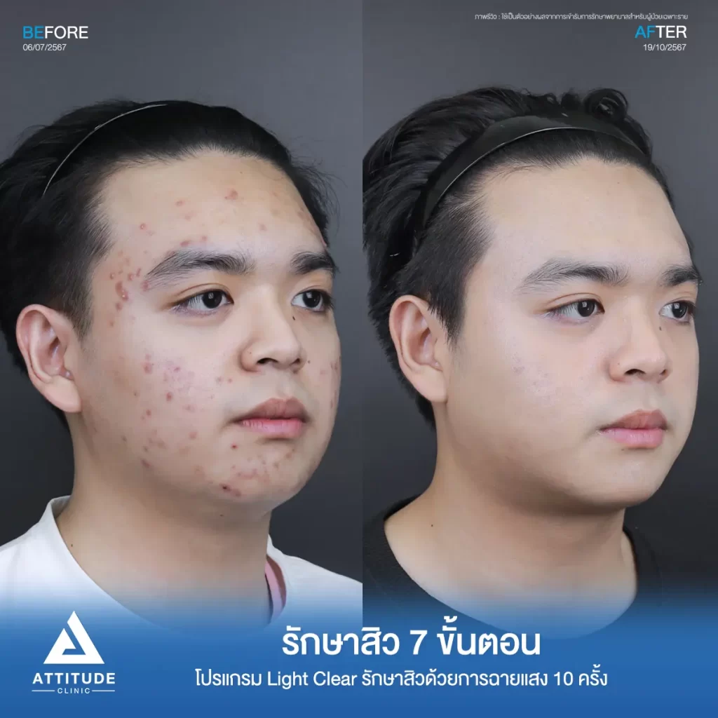 รีวิวรักษาสิวพี่ก้องภพ โปรแกรม Light Clear รักษาสิว 7 ขั้นตอน จำนวน 10 ครั้งที่ Attitude Clinic