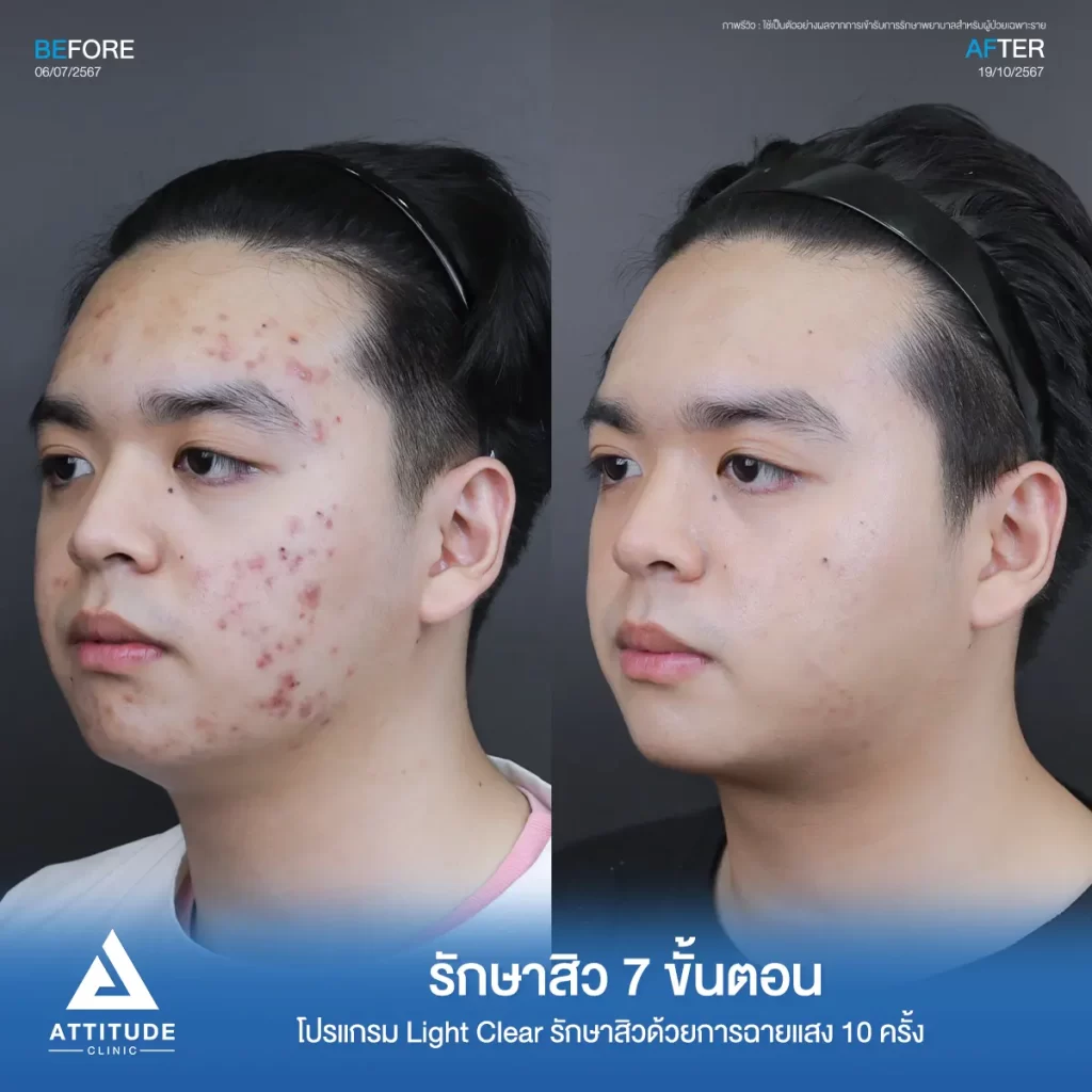 รีวิวรักษาสิวพี่ก้องภพ โปรแกรม Light Clear รักษาสิว 7 ขั้นตอน จำนวน 10 ครั้งที่ Attitude Clinic