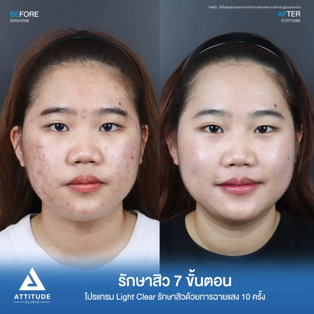 รีวิวรักษาสิวพี่ณัฐธิดา โปรแกรม Light Clear รักษาสิว 7 ขั้นตอน จำนวน 10 ครั้งที่ Attitude Clinic