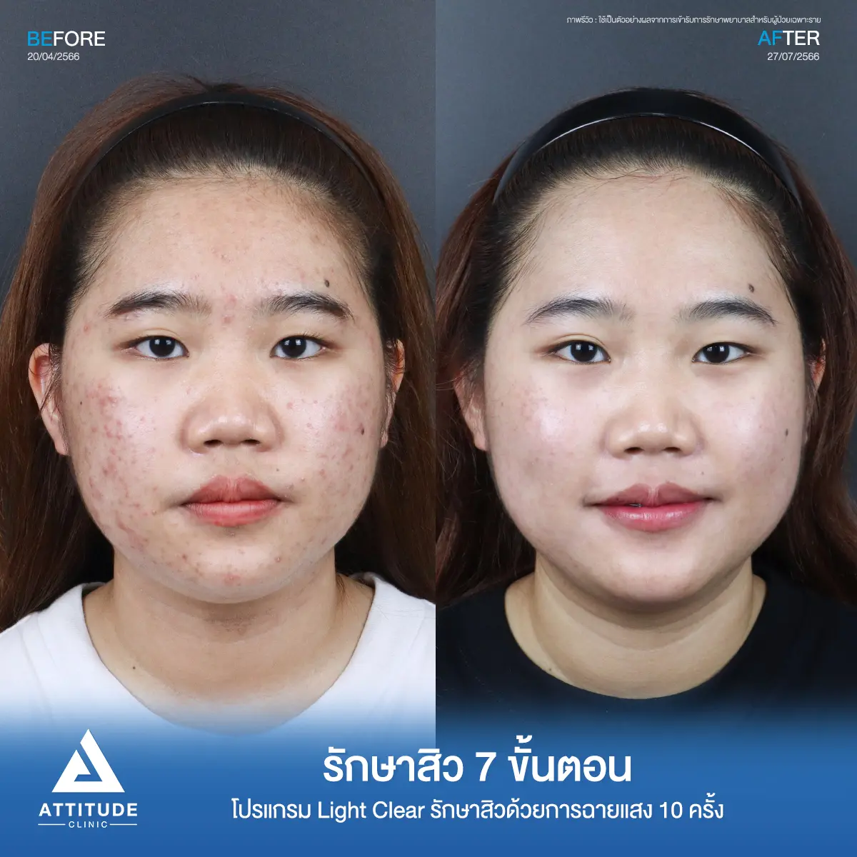 รีวิวรักษาสิวพี่ณัฐธิดา โปรแกรม Light Clear รักษาสิว 7 ขั้นตอน จำนวน 10 ครั้งที่ Attitude Clinic