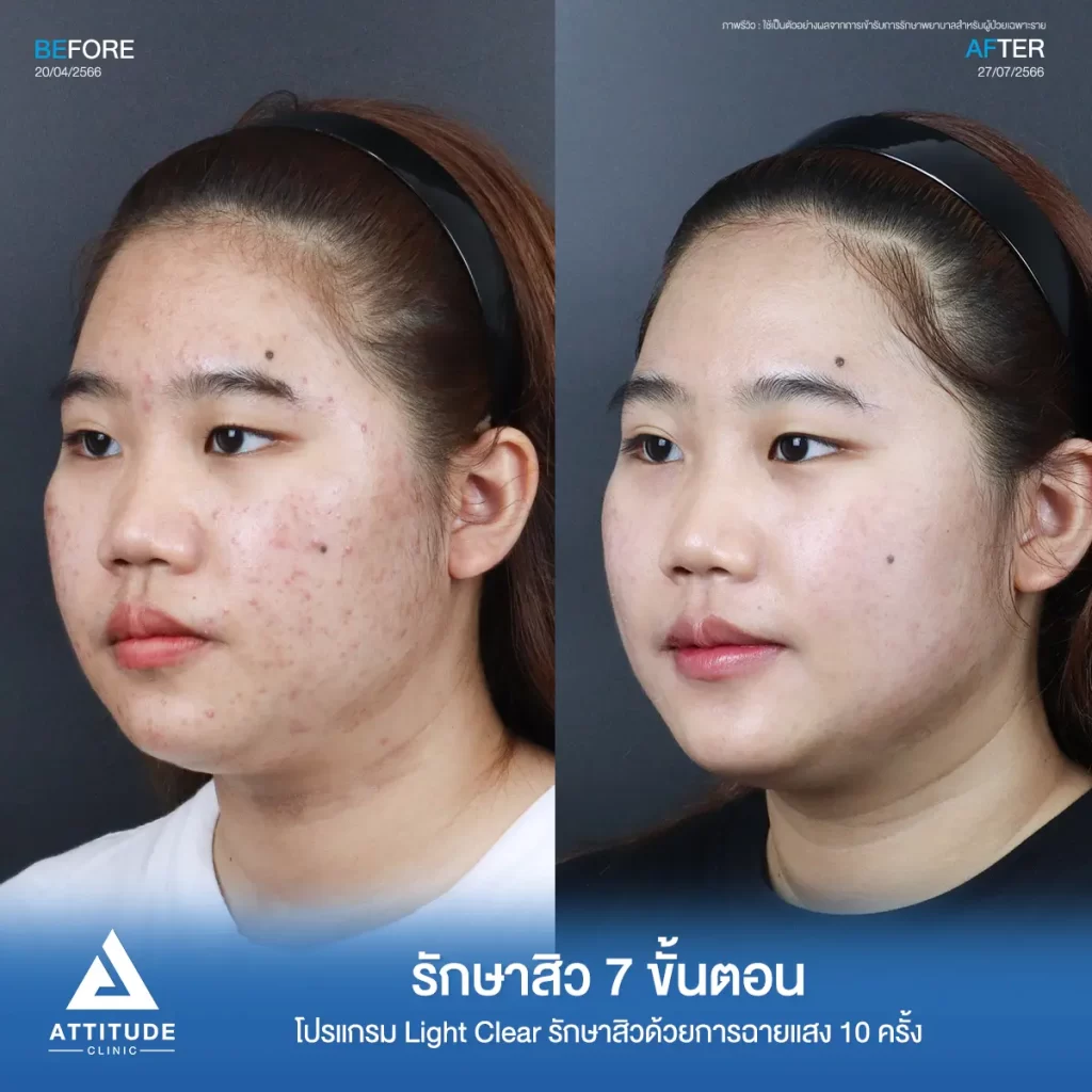 รีวิวรักษาสิวพี่ณัฐธิดา โปรแกรม Light Clear รักษาสิว 7 ขั้นตอน จำนวน 10 ครั้งที่ Attitude Clinic