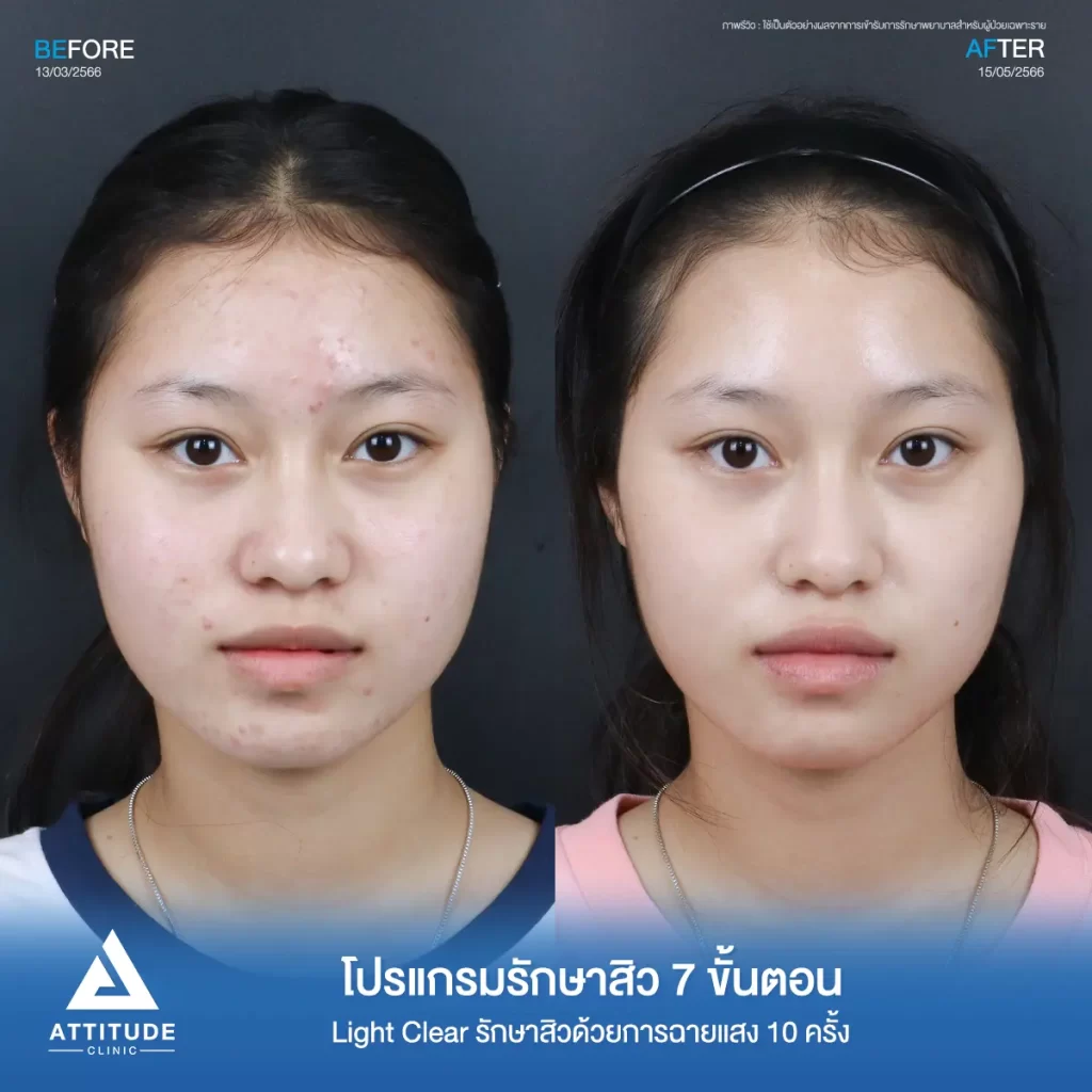 รีวิวรักษาสิวพี่ปาลิตา โปรแกรม Light Clear รักษาสิว 7 ขั้นตอน จำนวน 10 ครั้งที่ Attitude Clinic