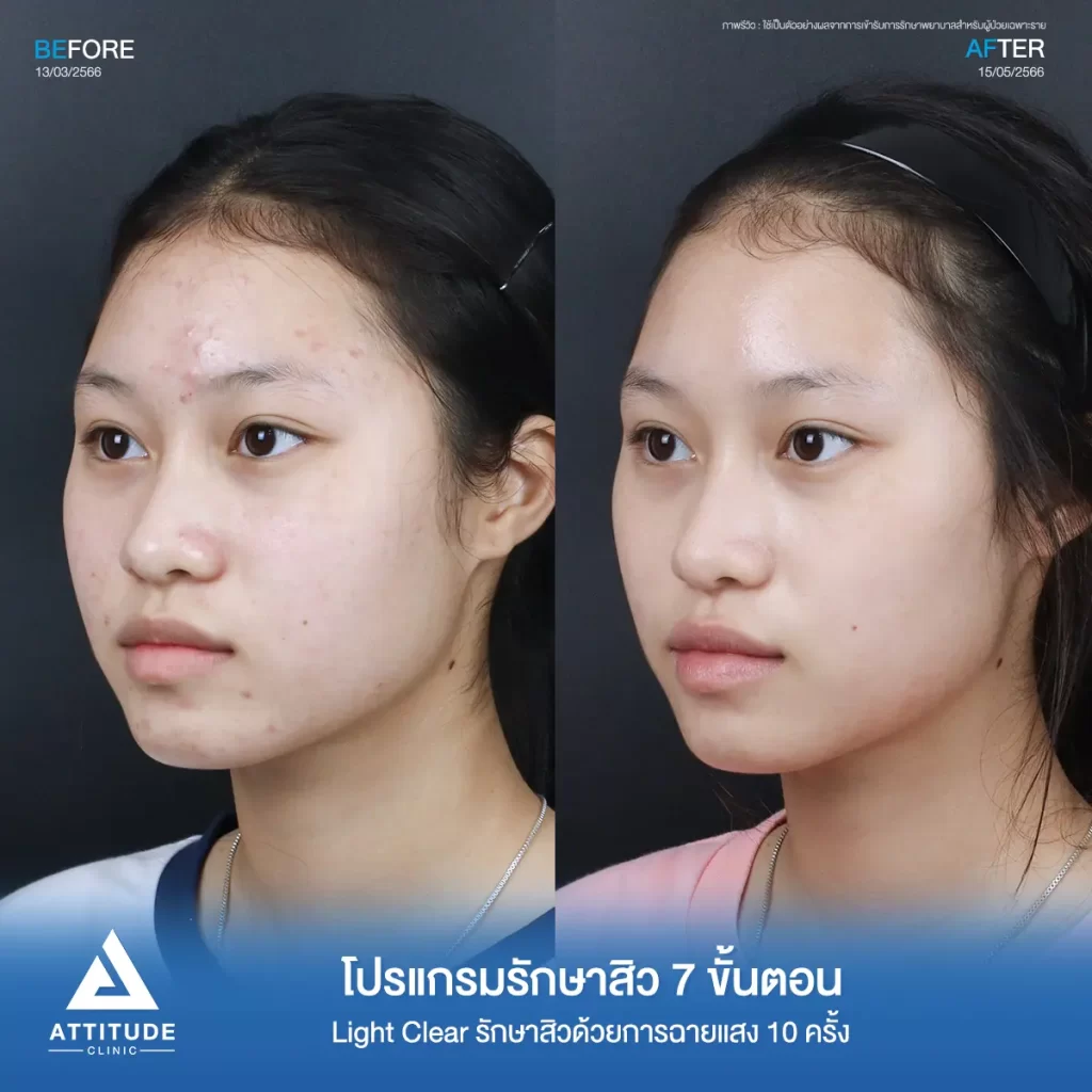 รีวิวรักษาสิวพี่ปาลิตา โปรแกรม Light Clear รักษาสิว 7 ขั้นตอน จำนวน 10 ครั้งที่ Attitude Clinic