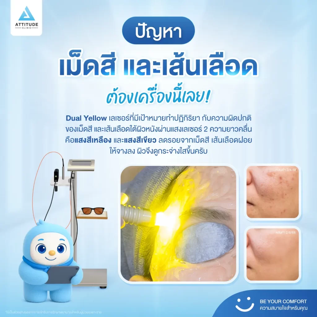 [เปิดตัวเครื่องใหม่] น้องกันเองพาชม! โปรแกรม Dual Yellow Laser เลเซอร์หน้าใส ตัวจบปัญหารอยดำ รอยแดง