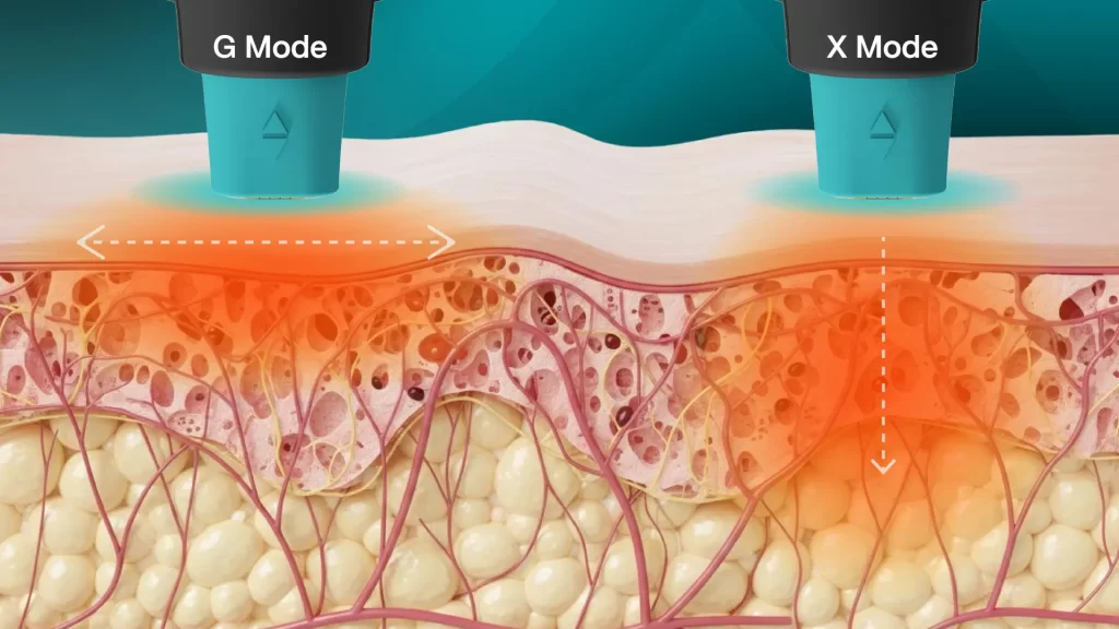 ข้อมูลครบ!! Oligio X ที่เชียงราย ,Oligio X ที่ห้วยขวาง เทคโนโลยียกกระชับผิวรุ่นใหม่ล่าสุด เย็น-ยุบ-ยก-นานมากขึ้นกว่ารุ่นเดิม!