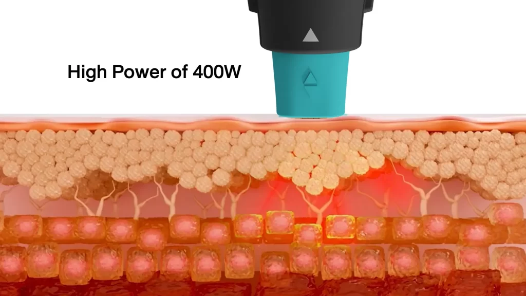 ข้อมูลครบ!! Oligio X ที่เชียงราย ,Oligio X ที่ห้วยขวาง เทคโนโลยียกกระชับผิวรุ่นใหม่ล่าสุด เย็น-ยุบ-ยก-นานมากขึ้นกว่ารุ่นเดิม!
