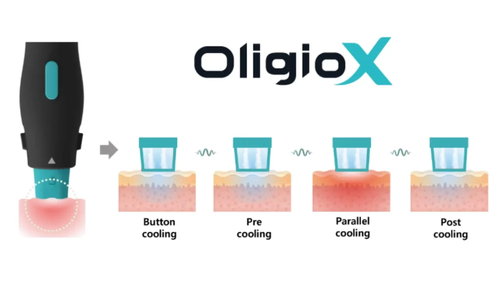 ข้อมูลครบ!! Oligio X ที่เชียงราย ,Oligio X ที่ห้วยขวาง เทคโนโลยียกกระชับผิวรุ่นใหม่ล่าสุด เย็น-ยุบ-ยก-นานมากขึ้นกว่ารุ่นเดิม!