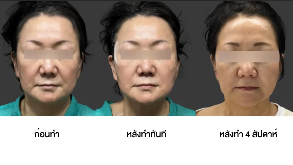 ข้อมูลครบ!! Oligio X ที่เชียงราย ,Oligio X ที่ห้วยขวาง เทคโนโลยียกกระชับผิวรุ่นใหม่ล่าสุด เย็น-ยุบ-ยก-นานมากขึ้นกว่ารุ่นเดิม!