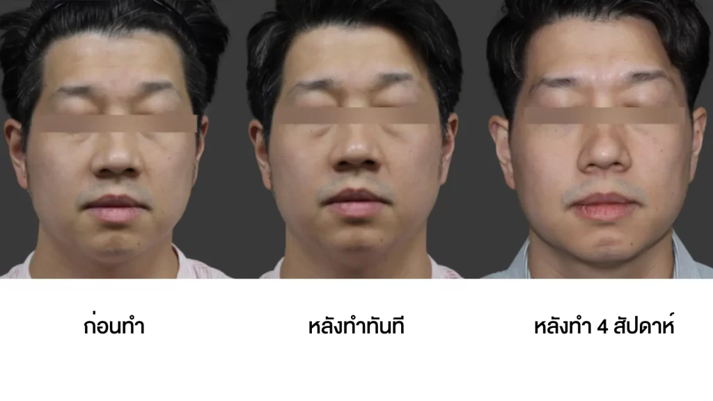 ข้อมูลครบ!! Oligio X ที่เชียงราย ,Oligio X ที่ห้วยขวาง เทคโนโลยียกกระชับผิวรุ่นใหม่ล่าสุด เย็น-ยุบ-ยก-นานมากขึ้นกว่ารุ่นเดิม!