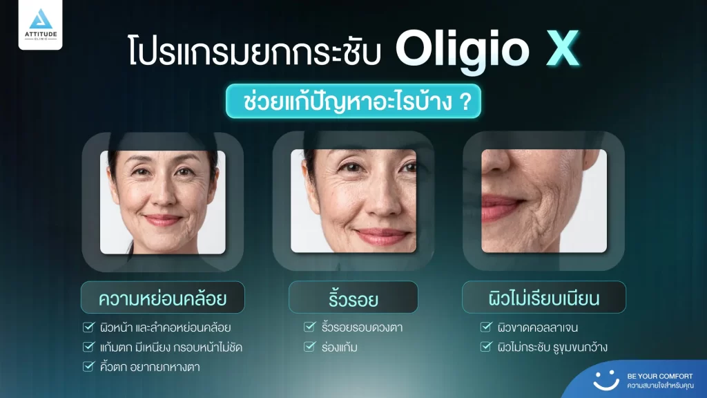 ข้อมูลครบ!! ทำความรู้จักโปรแกรมยกกระชับผิว Oligio X รุ่นใหม่ล่าสุด เย็น-ยุบ-ยก-นานมากขึ้นกว่ารุ่นเดิม! พร้อมเปิดตัวโปรแกรมยกกระชับผิว Oligio X ที่เชียงราย และ Oligio X ที่ลำปาง