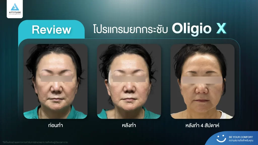 ข้อมูลครบ!! ทำความรู้จักโปรแกรมยกกระชับผิว Oligio X รุ่นใหม่ล่าสุด เย็น-ยุบ-ยก-นานมากขึ้นกว่ารุ่นเดิม! พร้อมเปิดตัวโปรแกรมยกกระชับผิว Oligio X ที่เชียงราย และ Oligio X ที่ลำปาง