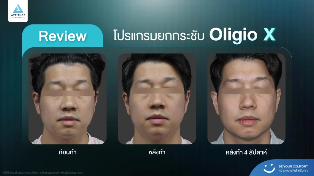 ข้อมูลครบ!! ทำความรู้จักโปรแกรมยกกระชับผิว Oligio X รุ่นใหม่ล่าสุด เย็น-ยุบ-ยก-นานมากขึ้นกว่ารุ่นเดิม! พร้อมเปิดตัวโปรแกรมยกกระชับผิว Oligio X ที่เชียงราย และ Oligio X ที่ลำปาง