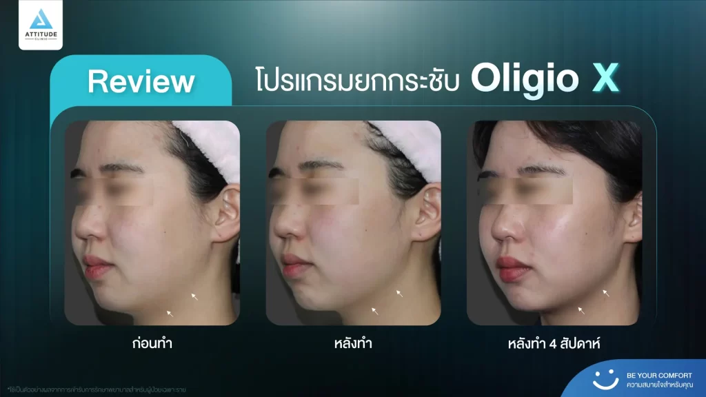 ข้อมูลครบ!! ทำความรู้จักโปรแกรมยกกระชับผิว Oligio X รุ่นใหม่ล่าสุด เย็น-ยุบ-ยก-นานมากขึ้นกว่ารุ่นเดิม! พร้อมเปิดตัวโปรแกรมยกกระชับผิว Oligio X ที่เชียงราย และ Oligio X ที่ลำปาง