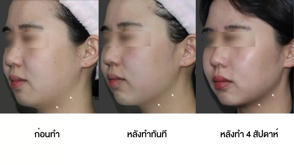 ข้อมูลครบ!! Oligio X ที่เชียงราย ,Oligio X ที่ห้วยขวาง เทคโนโลยียกกระชับผิวรุ่นใหม่ล่าสุด เย็น-ยุบ-ยก-นานมากขึ้นกว่ารุ่นเดิม!