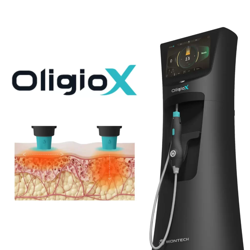 ข้อมูลครบ!! Oligio X ที่เชียงราย ,Oligio X ที่ห้วยขวาง เทคโนโลยียกกระชับผิวรุ่นใหม่ล่าสุด เย็น-ยุบ-ยก-นานมากขึ้นกว่ารุ่นเดิม!