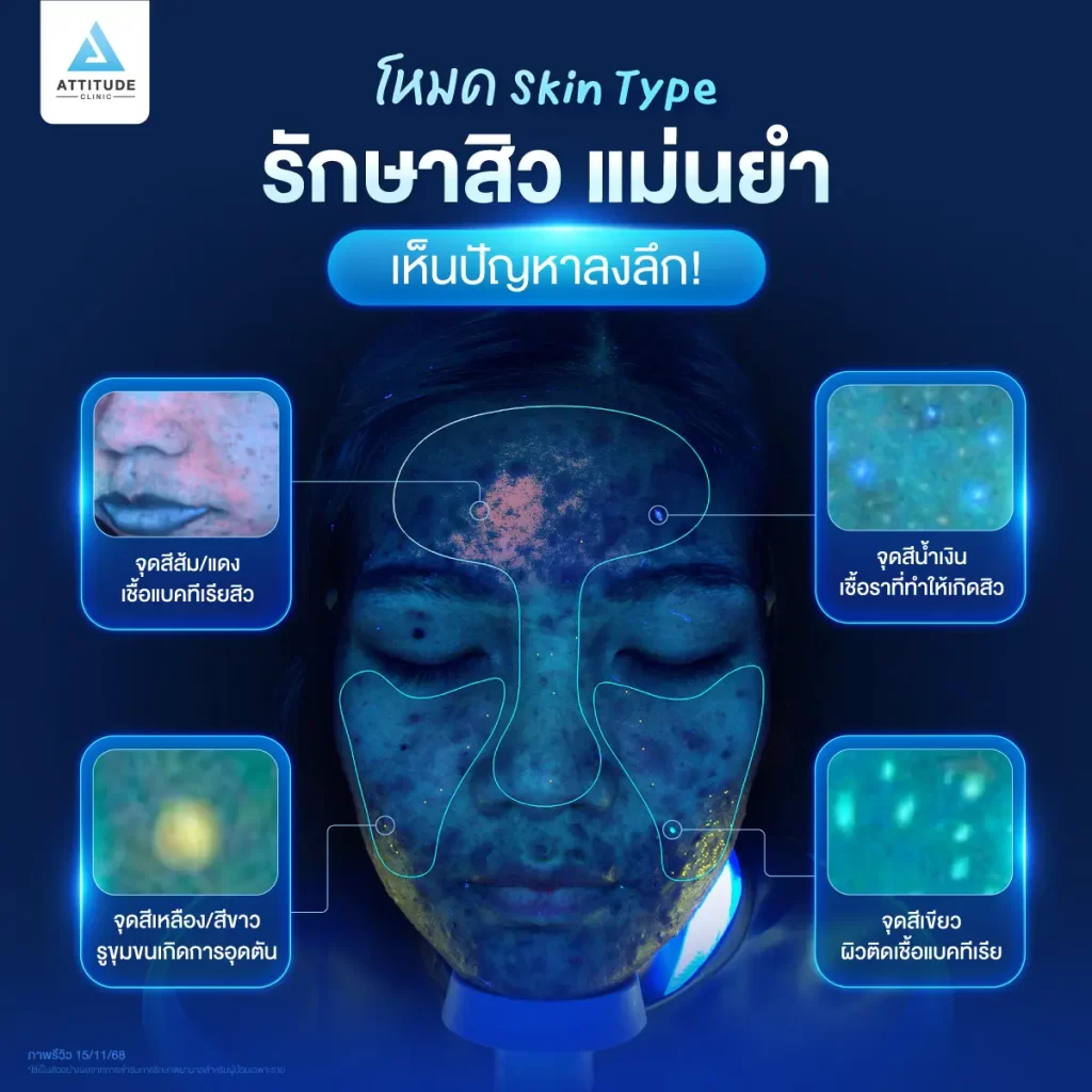 เครื่องสแกนหน้า 3D ตัวช่วยวางแผนรักษาสิวจากปัญหาผิวจริง