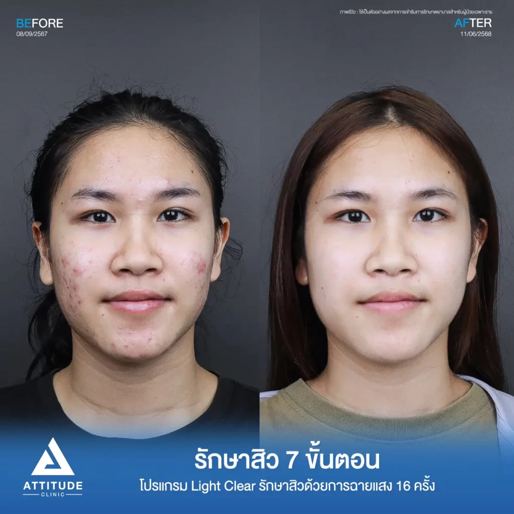 รีวิวรักษาสิวพี่วีซ่า ด้วยการฉายแสงโปรแกรม Light Clear รักษาสิว 7 ขั้นตอน จำนวน 16 ครั้งที่ Attitude Clinic