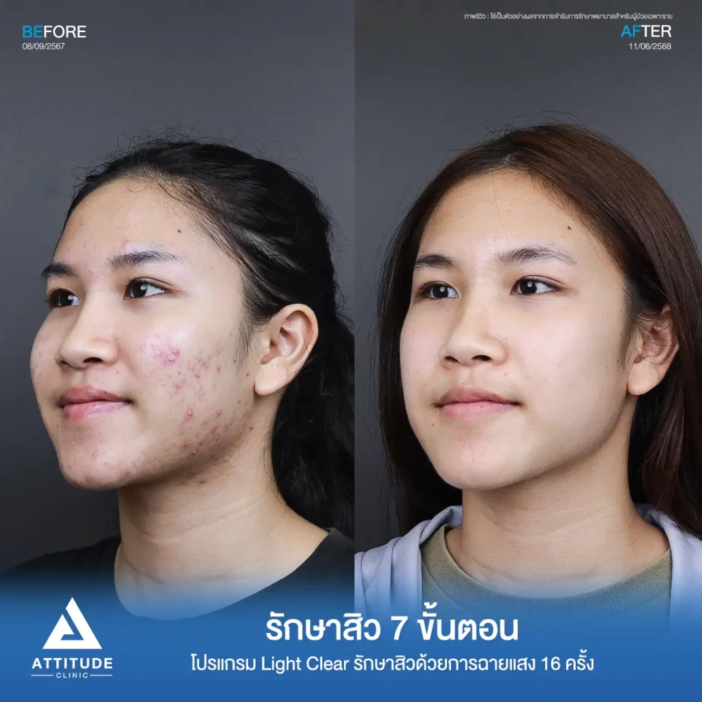 รีวิวรักษาสิวพี่วีซ่า ด้วยการฉายแสงโปรแกรม Light Clear รักษาสิว 7 ขั้นตอน จำนวน 16 ครั้งที่ Attitude Clinic 