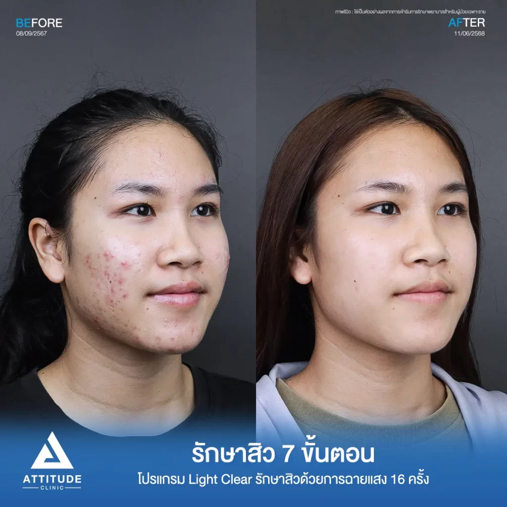 รีวิวรักษาสิวพี่วีซ่า ด้วยการฉายแสงโปรแกรม Light Clear รักษาสิว 7 ขั้นตอน จำนวน 16 ครั้งที่ Attitude Clinic 